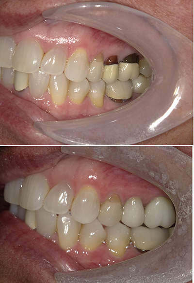 Magnolia Dental | Laser Treatment for Cold Sores   Aphthous Ulcers, Internal Bleaching and Crowns  amp  Caps