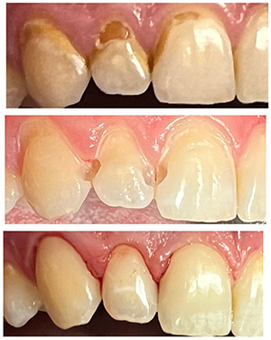 Magnolia Dental | Digital Impressions, Dental Fillings and Root Canals