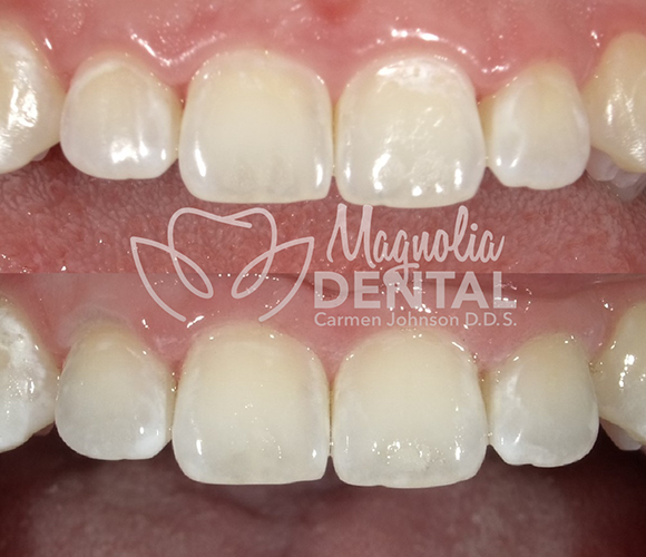 What Is A Composite Filling? - Magnolia Dental