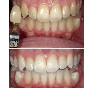 Magnolia Dental | Icon   Resin Infiltration, Cosmetic Dentistry and Gemini trade  Diode Laser