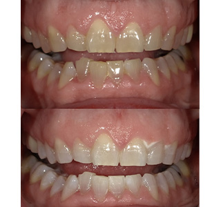 Magnolia Dental | Night Guards, Periodontal Treatment and K  R reg  Whitening