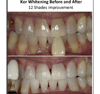 Magnolia Dental | Internal Bleaching, Pediatric Dentistry and Laser Treatment for Cold Sores   Aphthous Ulcers